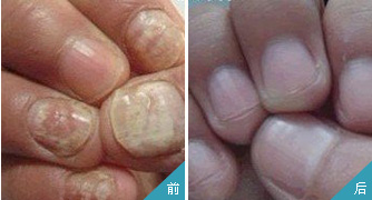 灰指甲怎樣預(yù)防呢